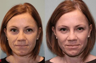 Laser Photo Rejuvenation Before & After