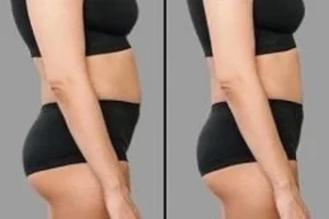 Liposonix Treatment Before & After