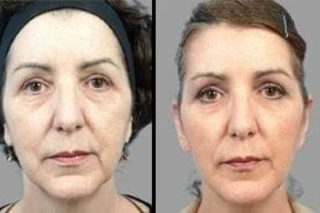 Microdermabrasion Before & After