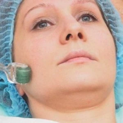 Microneedling in Dubai
