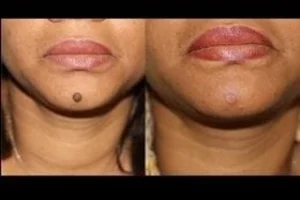 Mole Removal Before & After