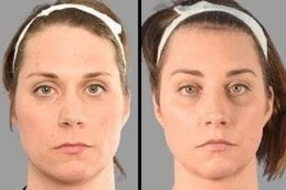 Oxygen Facial Before & After