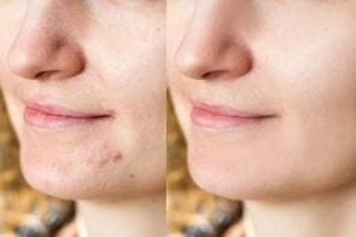 Pimples Treatment Before & After