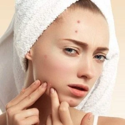 Pimples Treatment in Dubai