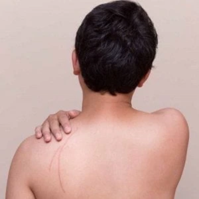 Post Surgical Scar Treatment in Dubai