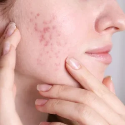 Radio Frequency For Acne Scars in Dubai
