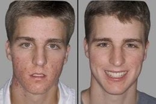 Radio Frequency for Acne Scars 6 Radio Frequency for Acne Scars Before and After