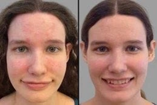 Rosacea Treatment 6 Rosacea Treatment Before & After