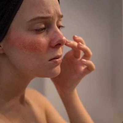 Rosacea Treatment in Dubai