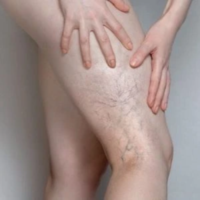 Sclerotherapy in Dubai