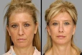 Skin Rejuvenation Before & After