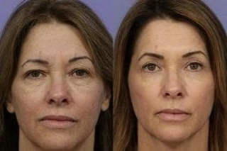 Skin Resurfacing Before & After