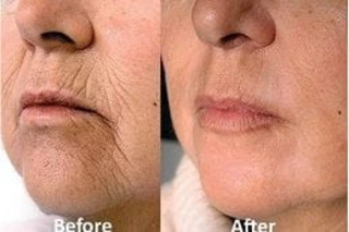 Skin Toning Treatment Before & After