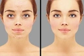 Skin Whitening Treatment in Dubai Before & After