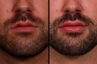 Smoker’s Lips Treatment 5 Before & After Smokers Lips Treatment