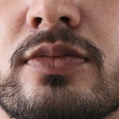 Smoker’s Lips Treatment in Dubai