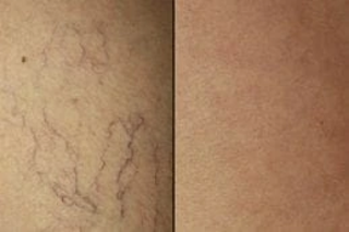 Spider Veins Treatment Before & After