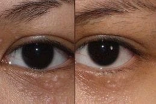 Syringoma Removal Before & After