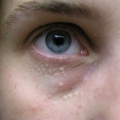 Syringoma Removal Treatment