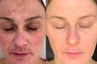Before & After Cosmelan Peel Treatment