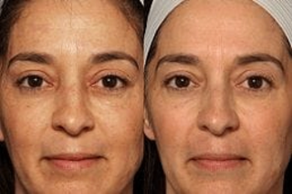 Before & After Erbium peel