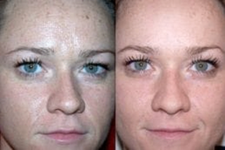 Before & After Glycolic Acid Peel in Dubai