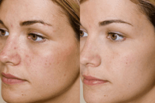 Before & After Glycolic Acid Peel