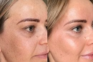 Cosmelan Peel Treatment Before & After