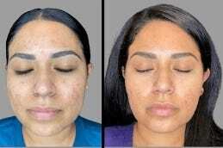 Dermamelan Treatment Before & After