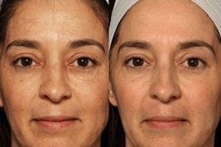 Erbium peel Before & After