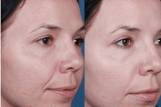 Glycolic Acid Peel Before & After